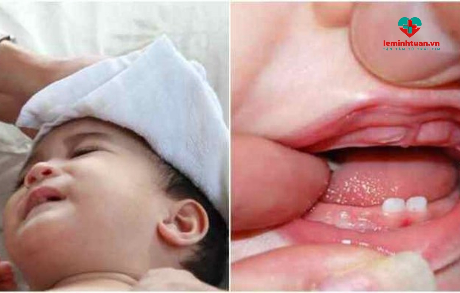 Những lưu ý khi trẻ sốt mọc răng