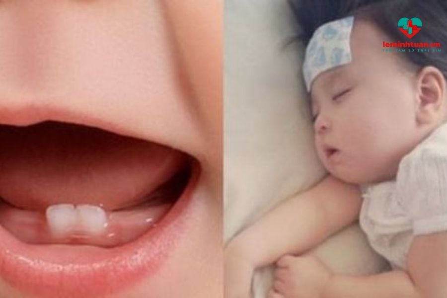 Trẻ em sốt bao nhiêu ngày khi khỏi khi mọc răng