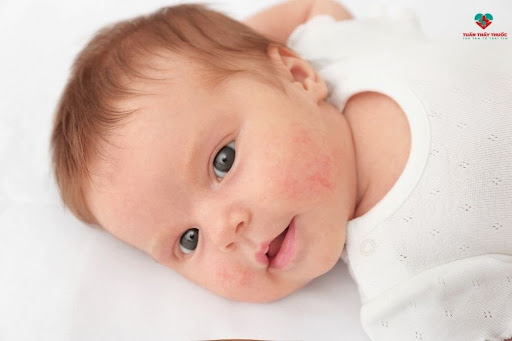 Phát ban trên da ở trẻ sơ sinh khi bị dư vitamin C 
