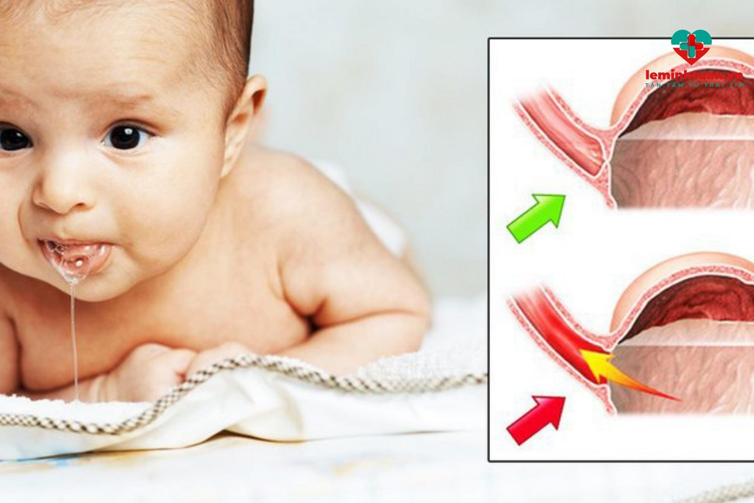 Trẻ 2 tuổi ăn vào là bị nôn do bé bị trào ngược dạ dày thực quản