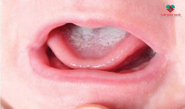 nấm lưỡi ở trẻ sơ sinh