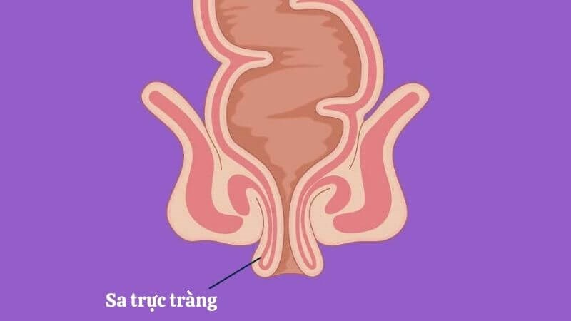 benh-sa-truc-trang