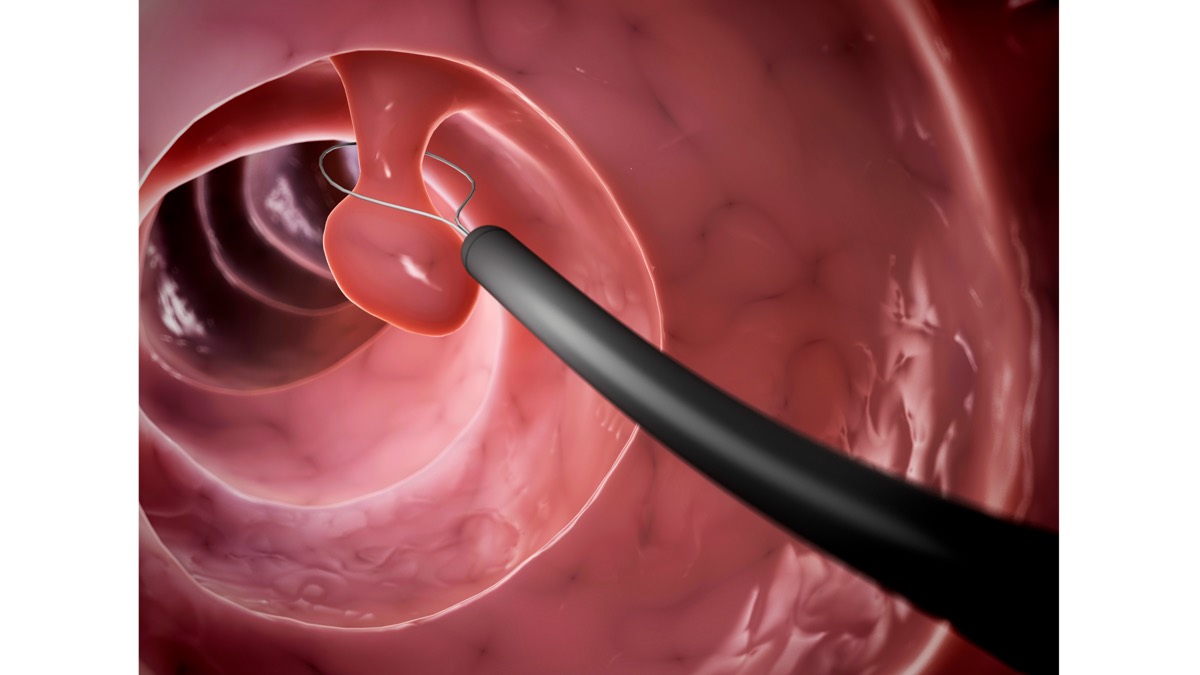 Những Việc TUYỆT ĐỐI Tránh Khi Bị Táo Sau Cắt Polyp