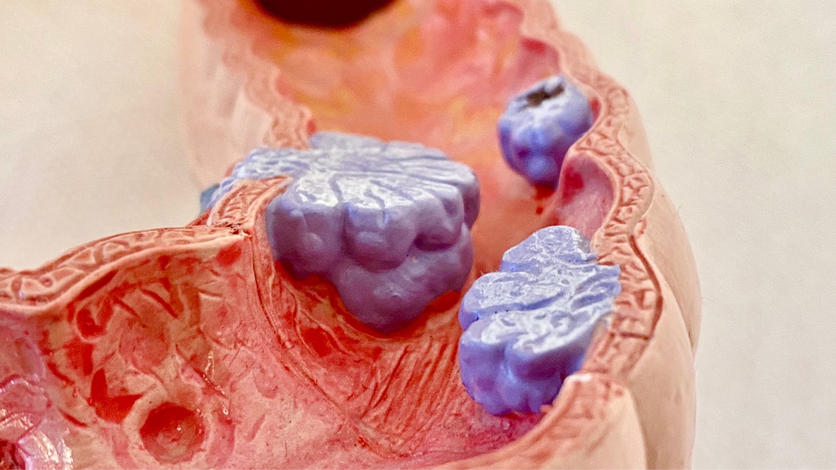 Polyp đại tràng