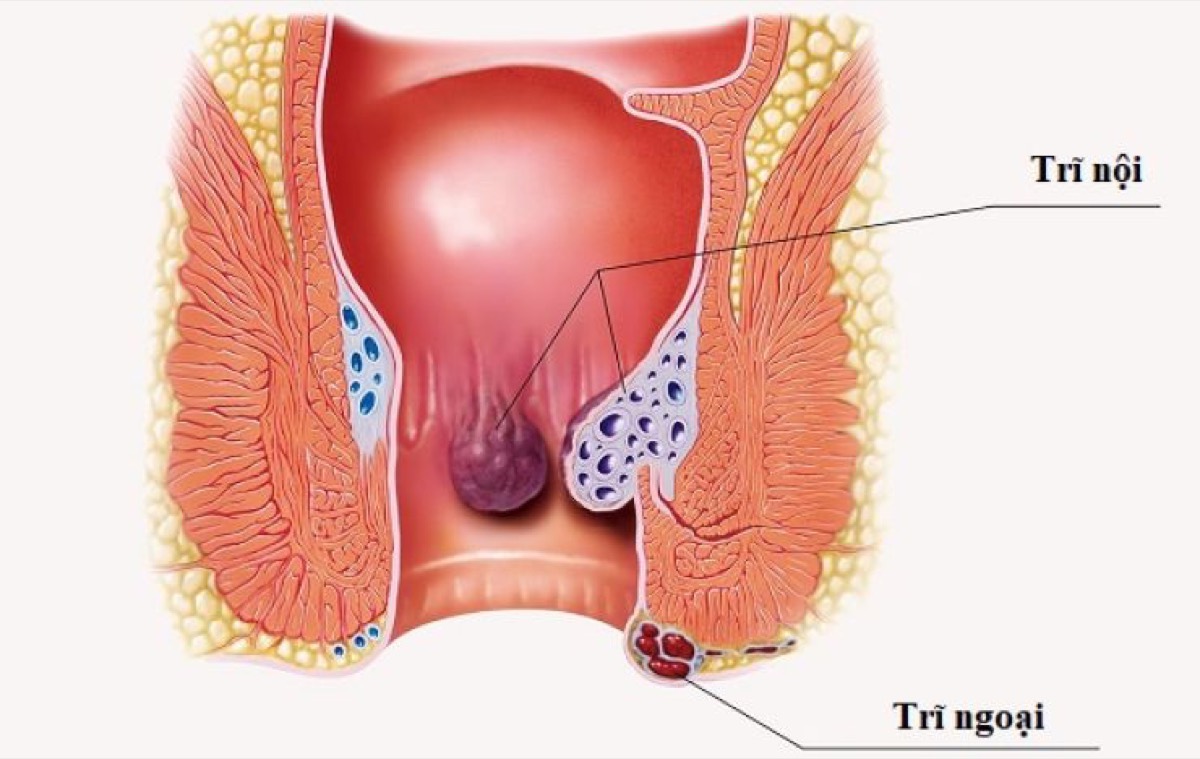 Bước 4 — Ngâm Nước Ấm Và Chăm Sóc Búi Trĩ Đỡ Đau